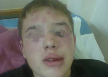 В Корабельном районе неизвестные сильно избили ребенка. Родители избитого подозревают, что милиция затягивает дело