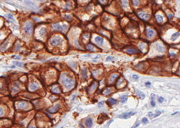 ВОЗ сделала неутешительные прогнозы по росту онкологических заболеваний на следующие 20 лет