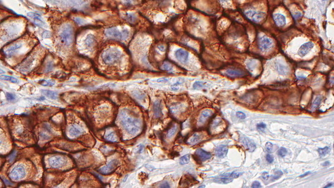 ВОЗ сделала неутешительные прогнозы по росту онкологических заболеваний на следующие 20 лет