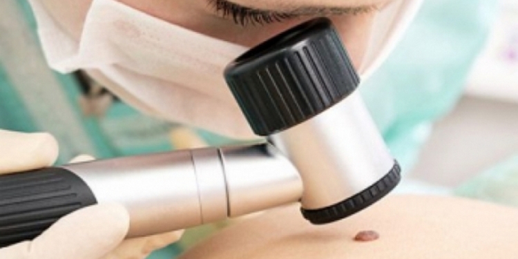 Результаты Дня борьбы с меланомой в Николаевской области: из 604 обследованных 12 направлены на углубленное обследование