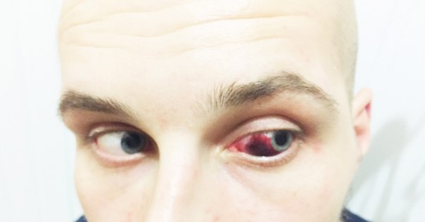 В Херсоне депутата ОппоБлока, откусившего ухо активисту, посадили под домашний арест