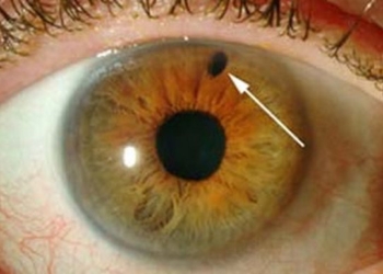 Неделя борьбы с глаукомой в Николаевской областной офтальмологической больнице: из 126 осмотренных у 11 выявлена глаукома