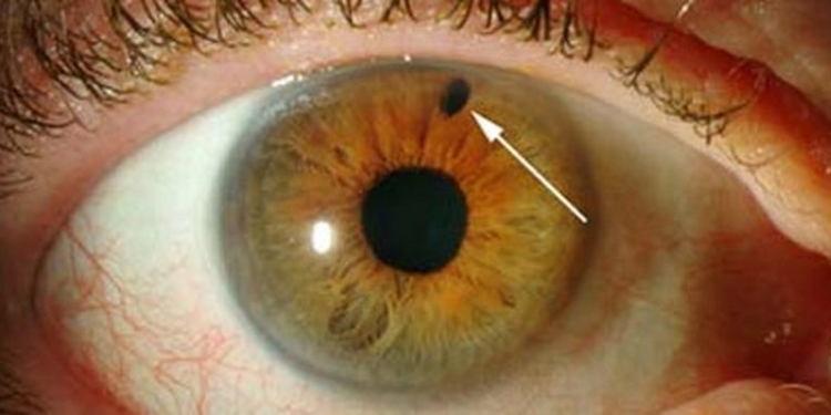Неделя борьбы с глаукомой в Николаевской областной офтальмологической больнице: из 126 осмотренных у 11 выявлена глаукома
