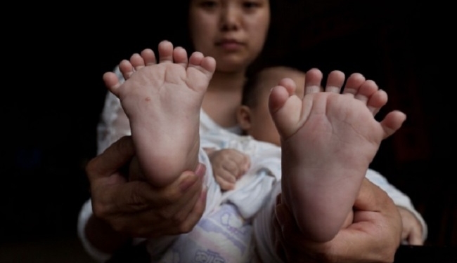 В Китае родился мальчик, у которого 31 палец – на руках и ногах