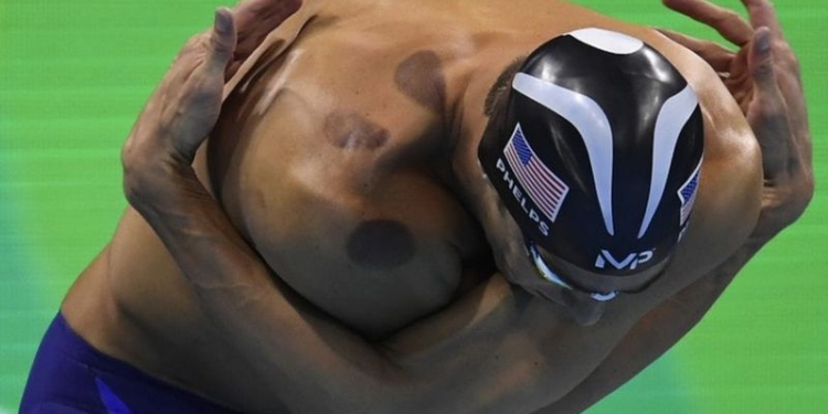 Новая жизнь старого метода: пятна на Фелпсе напомнили о буме медицинских банок в США