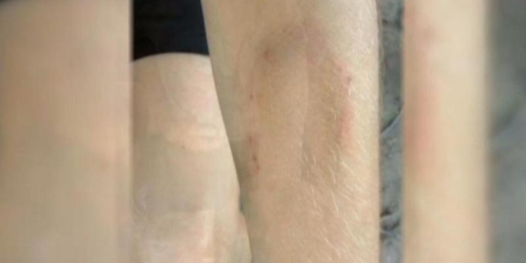 Озверение? В Кривом Роге пенсионерка покусала школьника