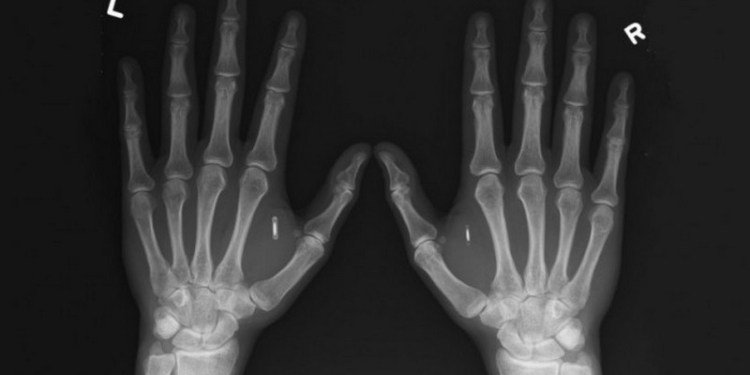 Первому украинцу имплантировали компьютерный чип в руку