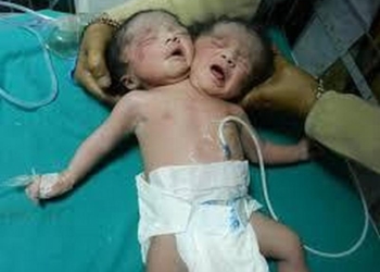 Не только в животном мире такое встречается: в Индии родился ребенок с двумя головами