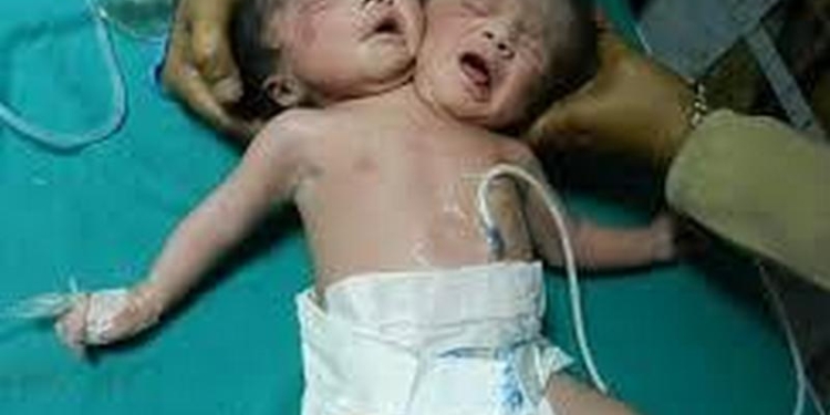 Не только в животном мире такое встречается: в Индии родился ребенок с двумя головами
