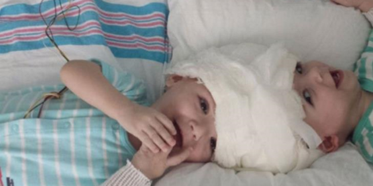 В США провели успешную операцию по разделению сиамских близнецов