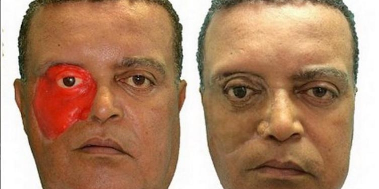 Технологии в помощь: с помощью 3D-печати изготовлен первый протез лица