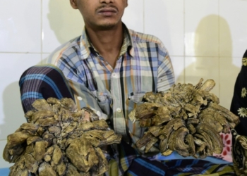 «Человек-дерево» из Бангладеш перенес 16 операций, чтобы избавиться от своих жутких наростов