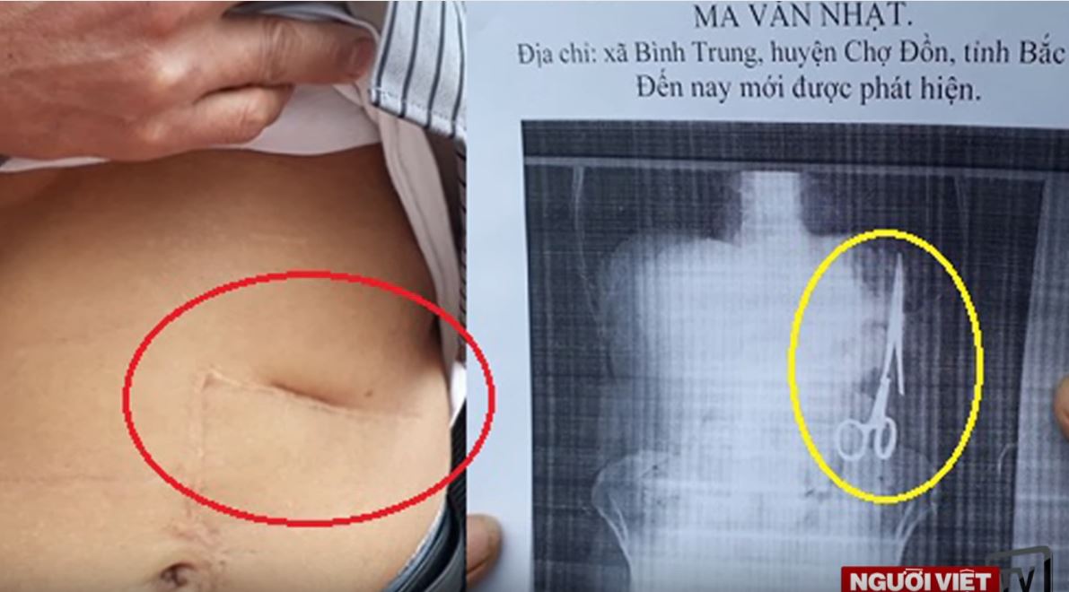 Во Вьетнаме в животе у пациента обнаружили ножницы. Через 18 лет после операции