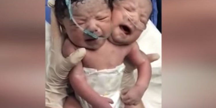 Ужас. В Мексике родился двухголовый ребенок