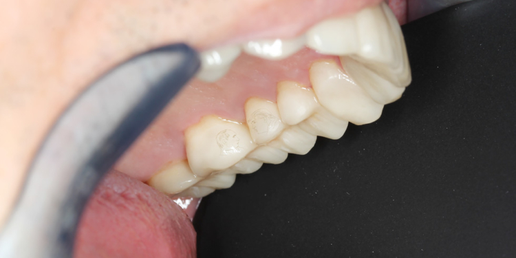 Зуб даю. С Путиным и Трампом. Модная в РФ гравировка на зубах