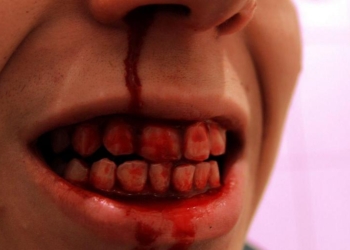 Политические страсти: в споре из-за Трампа мужчина откусил ухо соседу