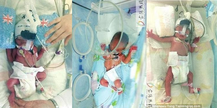 Бывает и так: в Китае на свет появились две девочки спустя неделю после рождения их брата