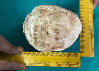 В Индии мужчине из мочевого пузыря удалили камень весом 1,4 кг