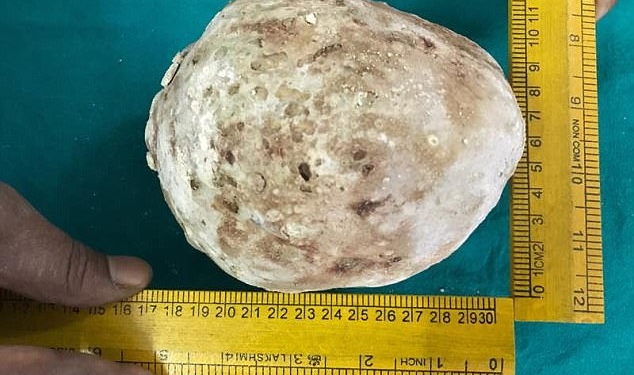 В Индии мужчине из мочевого пузыря удалили камень весом 1,4 кг