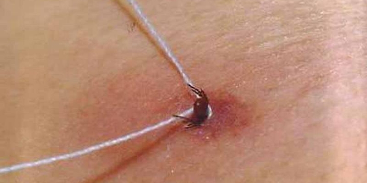 В Николаеве в этом сезоне уже три случая болезни Лайма. Что делать, если вас укусил клещ?