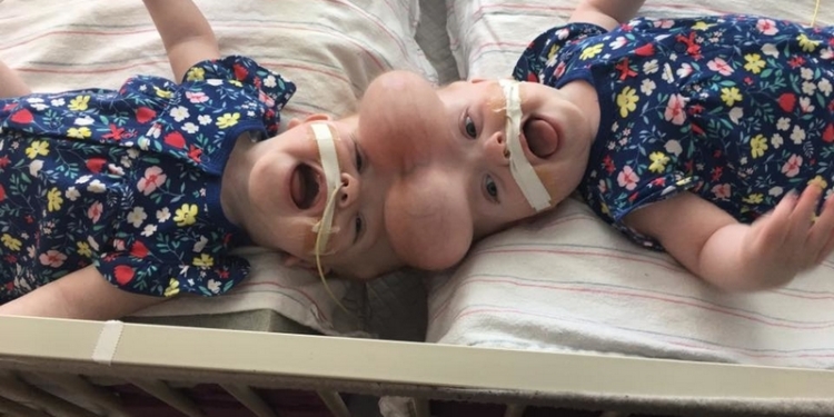 Уникальная операция по разделению двух сиамских близнецов в США длилась 11 часов