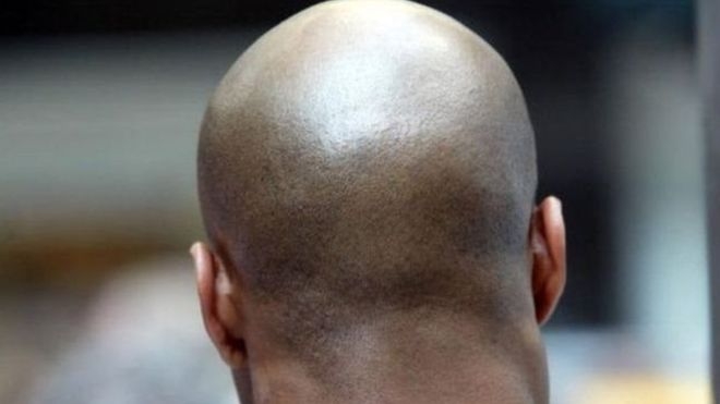 В Африке убивают лысых – ради денежных ритуалов