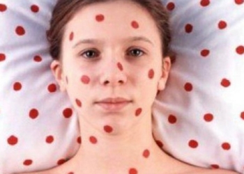 Минздрав сообщил о вспышке кори в Украине – многие из заболевших не были привиты