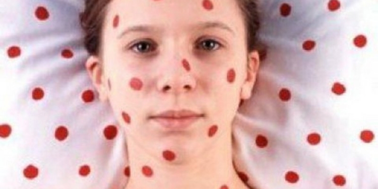 Минздрав сообщил о вспышке кори в Украине – многие из заболевших не были привиты
