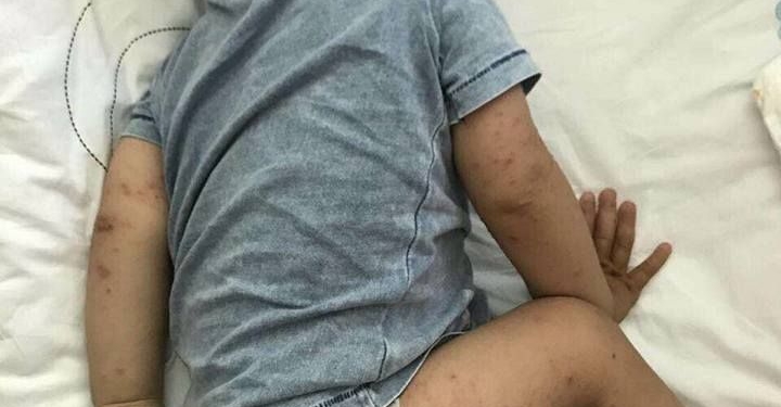 Отдыхающие из Украины подхватили вирус Коксаки на курорте в Турции. Чем он опасен?