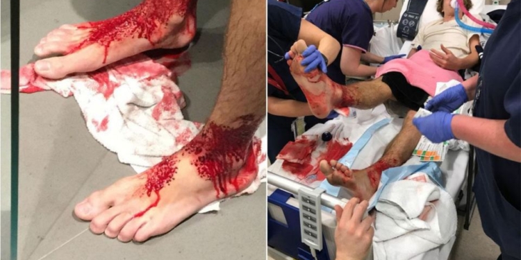 В Австралии подростка сильно искусали неизвестные морские животные