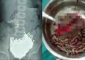 Хирурги извлекли 600 гвоздей из желудка пациента