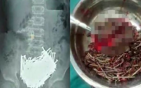 Хирурги извлекли 600 гвоздей из желудка пациента
