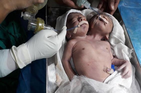 Нервным не смотреть. В Индии родились редкие сиамские близнецы