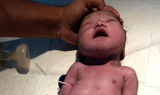 С хвостом вместо ног. В Индии родился ребенок-русалка