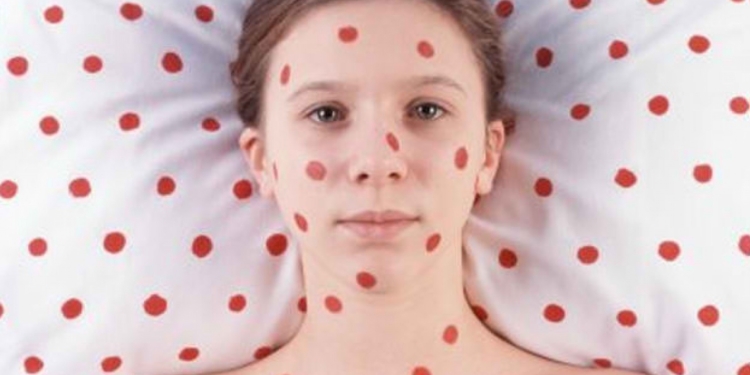 Во Львовской области – вспышка кори. Причем пока заболели работники одного предприятия