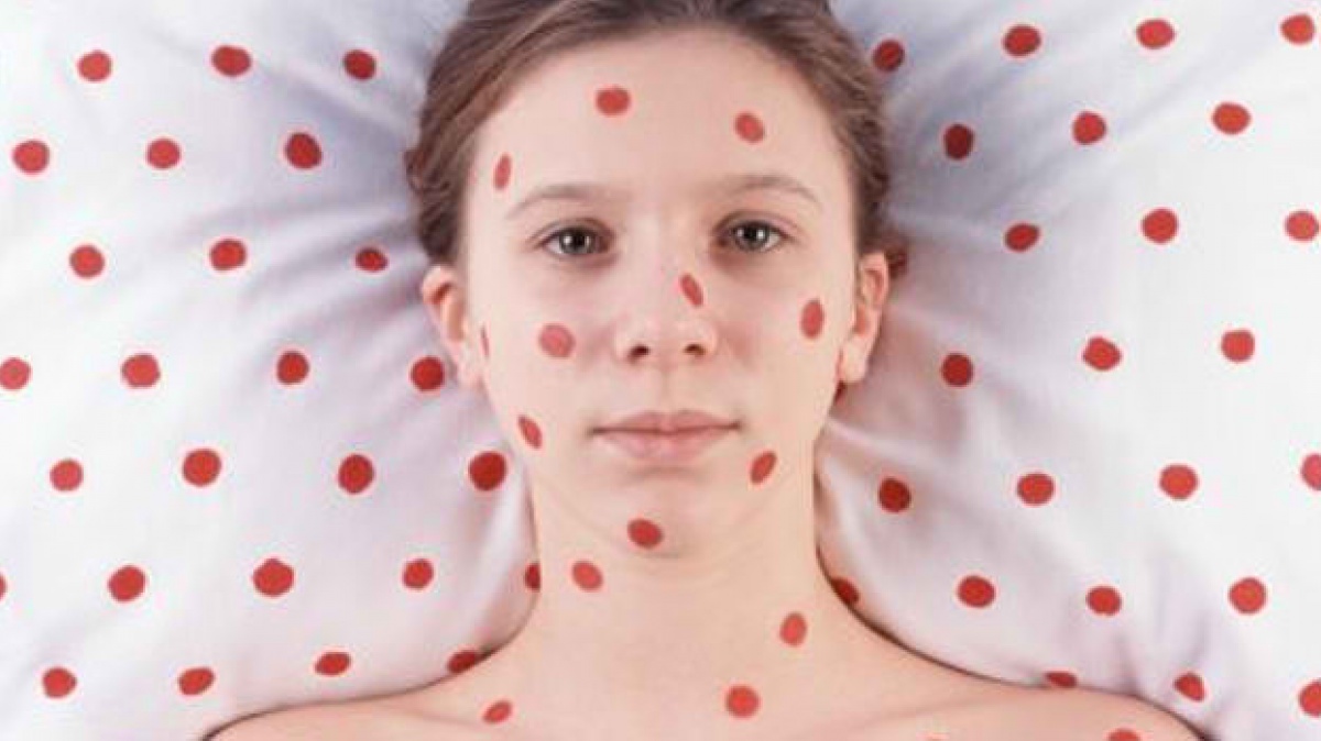 Во Львовской области – вспышка кори. Причем пока заболели работники одного предприятия