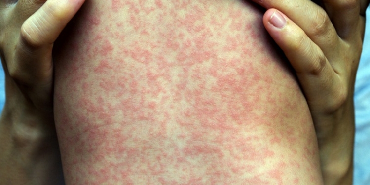 В Одесской области от осложнений кори умер пятилетний ребенок