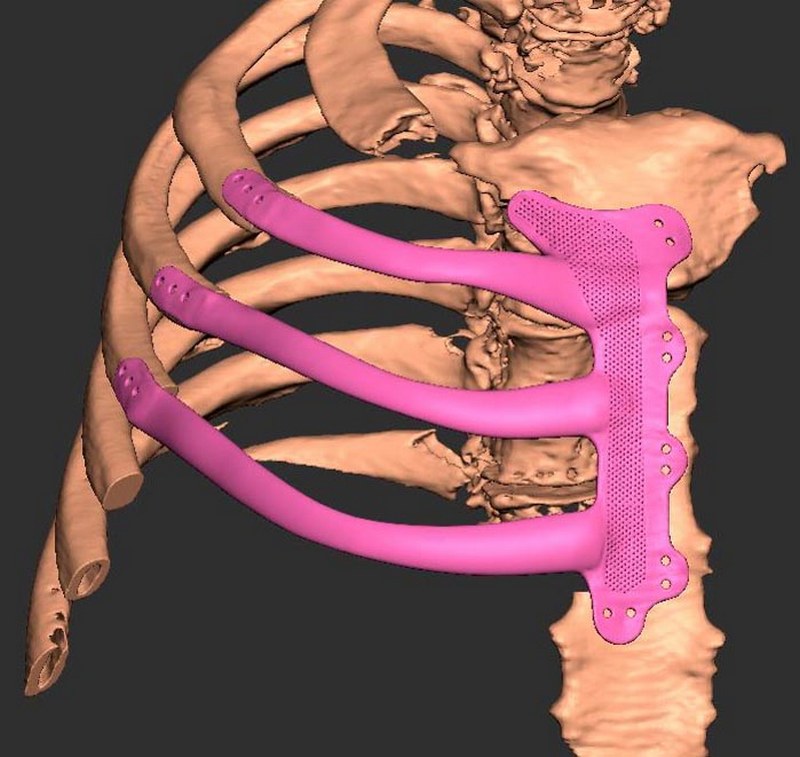 В Британии врачи напечатали пациенту грудную клетку на 3D-принтере 2