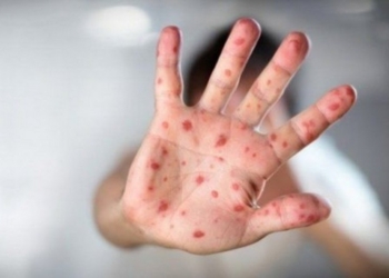 Украина в прошлом году заняла 3-е место в Европе по количеству случаев заболевания корью – зафиксировано 4767 случаев