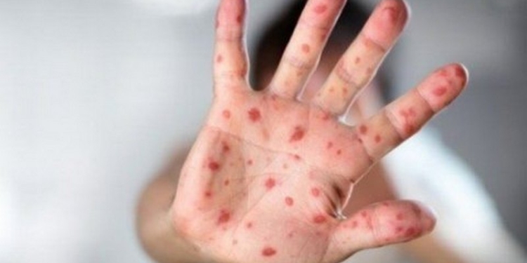 Украина в прошлом году заняла 3-е место в Европе по количеству случаев заболевания корью – зафиксировано 4767 случаев