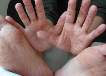 За прошедшую неделю количество заболевших корью в Первомайске выросло