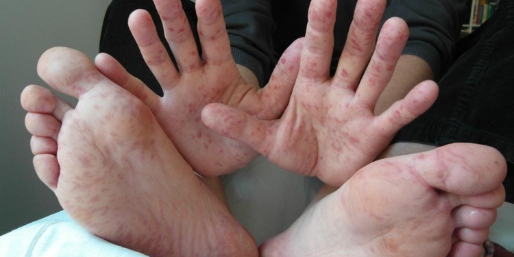 За прошедшую неделю количество заболевших корью в Первомайске выросло