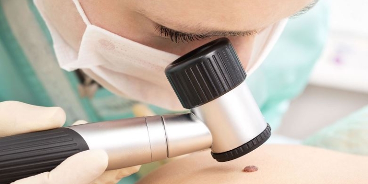 В рамках Всеукраинской дня меланомы николаевцев зовут проверить свои родинки