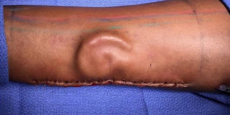 У американки на руке выросло ухо