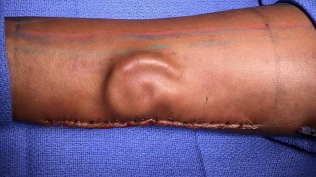 У американки на руке выросло ухо