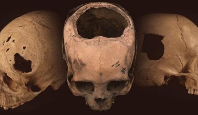 Хирурги инков оказались эффективнее врачей ХІХ века