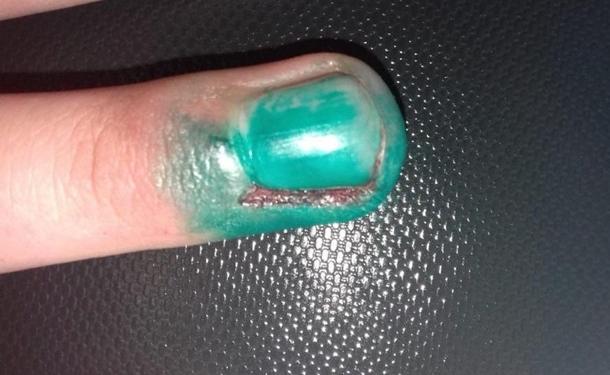 Стычки под Одессой: помощник депутата укусил полицейского