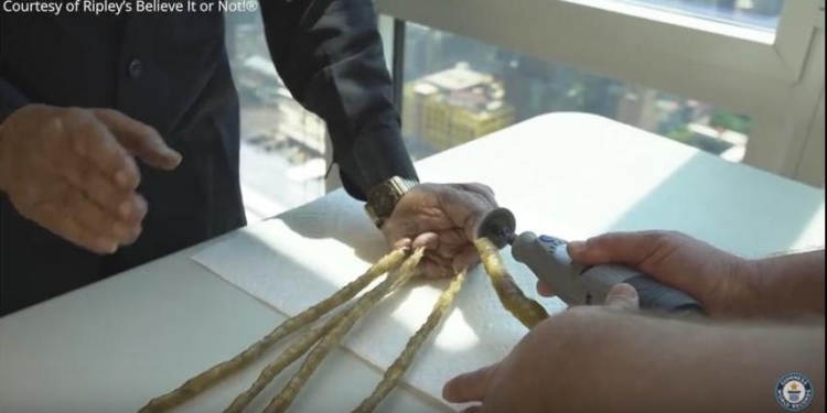 И зачем было растить 66 лет? Индиец наконец-то «расстался» со своими почти двухметровыми ногтями