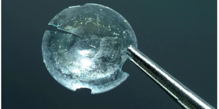 Медики нашли в глазу пациентки контактную линзу, забытую там 28 лет назад