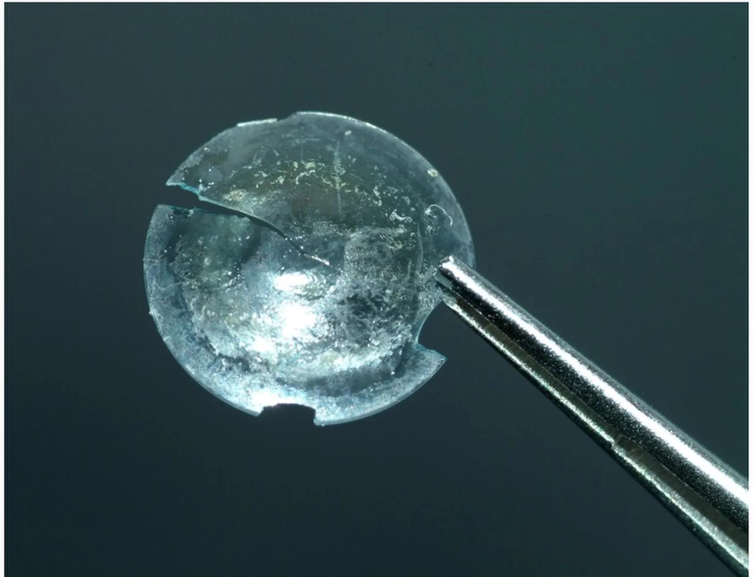 Медики нашли в глазу пациентки контактную линзу, забытую там 28 лет назад